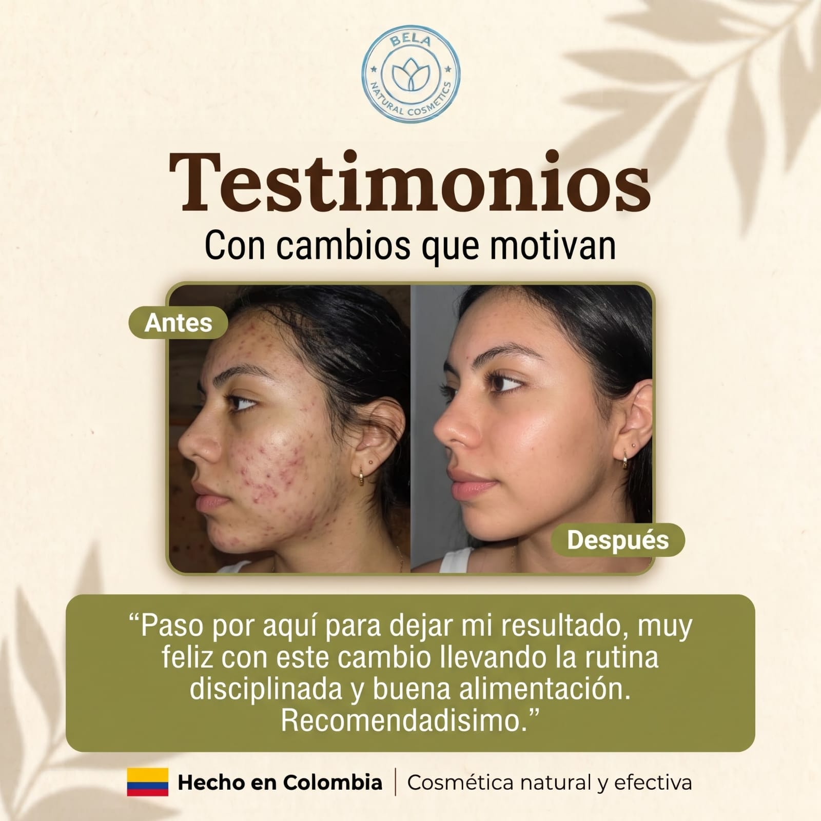 Testimonio de clienta Bela: antes y después del acné en mejilla y mandíbula