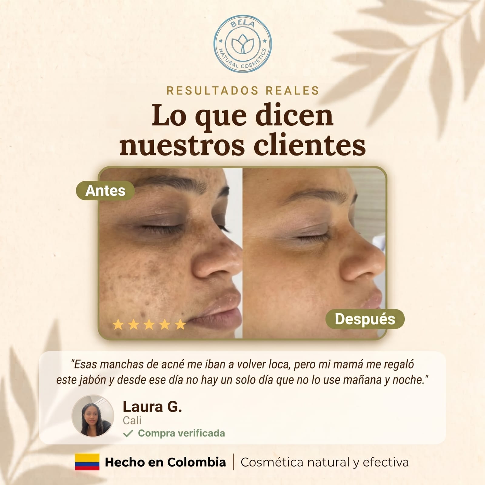 Antes y después de clienta Bela: reducción de marcas de acné en el rostro